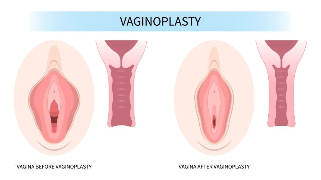 Vaginal teshikning fotosurati